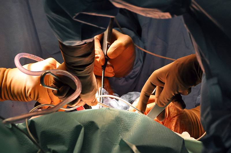 Adult Fracture Fixation